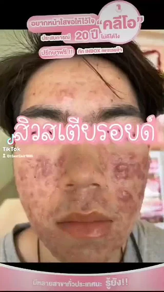 คลีโอ สกิน รักษาสิวลำปาง Cleo Skin Lampang