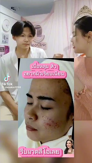 คลีโอ สกิน รักษาสิวพิษณุโลก Cleo Skin pitsanulok